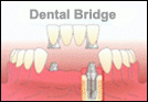 Oakville Dental Implants
