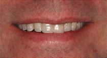 Oakville Dental Implants