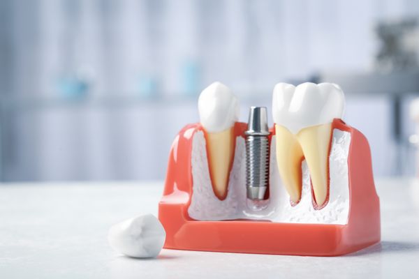 implant-screw-model-on-white-surface-600w-1